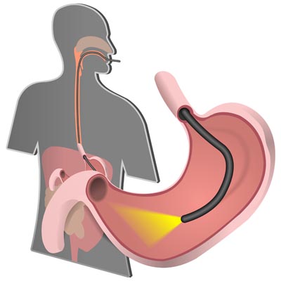Drawing of an endoscope in a patient's stomach