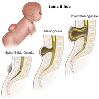 Illustration of three different degrees of spina bifida