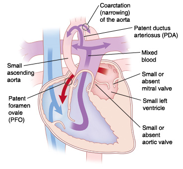 Four-chamber view of heart showing hypoplastic left heart syndrome. Arrows indicate blood flow through heart.