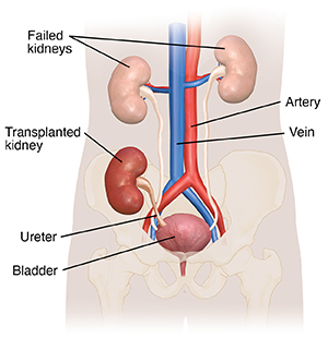 Front view of urinary tract with kidneys, ureters, bladder, and urethra, showing position of transplanted kidney.