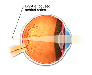 Cross section of eye showing hyperopia, with light focusing behind retina.