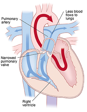 Four-chamber view of heart showing pulmonary stenosis. Arrows indicate less blood flowing through pulmonary valve.