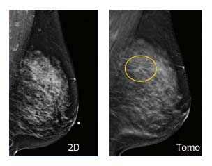 2D Vs. Tomo Breast Imaging 