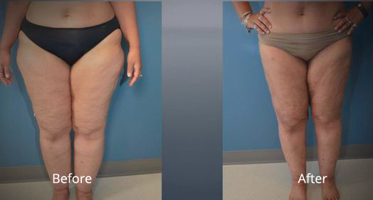 before and after of lipedema dr. dan buck christian hospital before and after of lipedema dr. dan buck christian hospital