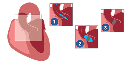 tavr procedure graphic christian hospital tavr procedure graphic christian hospital